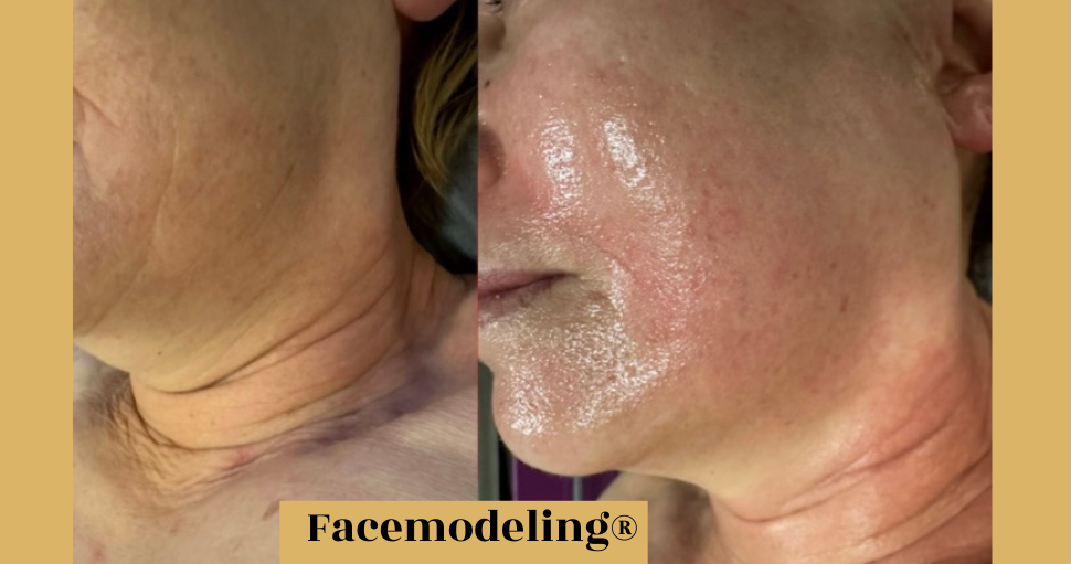 Rehabilitacja estetyczna twarzy – Facemodeling®